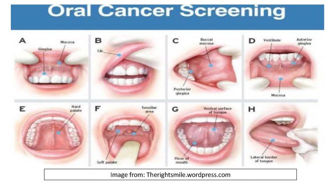 Oral Cancer – Problem Solving Through Case Studies